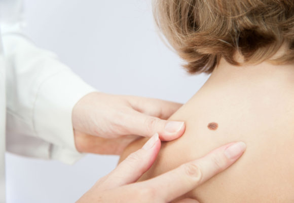 A healthcare staff person checks a mole on a patient's left shoulder