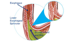 Graphic of the stomach and esophagus. Text with arrows pointing to Esophagus, Lower Esophageal Sphincter, and Stomach Acid and Bile.