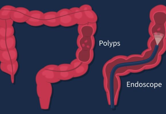 Illustration of colonoscopy