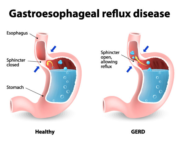 Gastroesophageal Reflux Disease picture