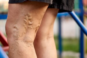 varicose and spider veins on back of woman's legs