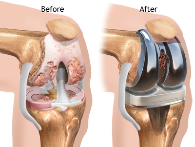 illustration of knee replacement before and after