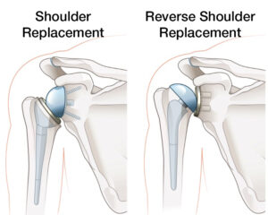 illustration of total shoulder replacement and reverse shoulder replacement