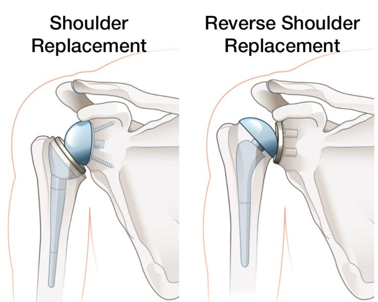 Shoulder Remy Shoulder Surgery | Glacial Ridge Health System