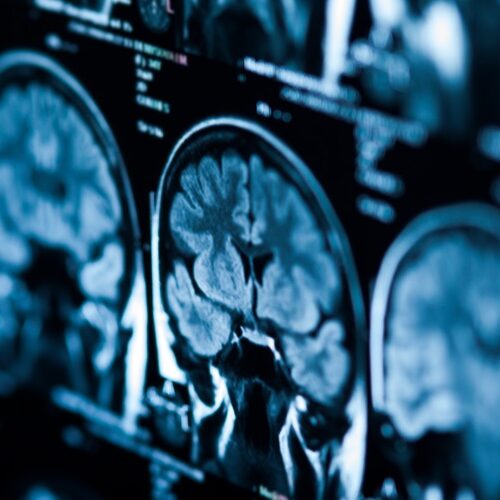 multiple MRI brain scans