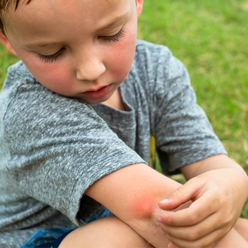Boy Bug Bite Young boy