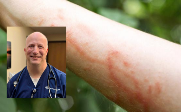 Poison Ivy Rash