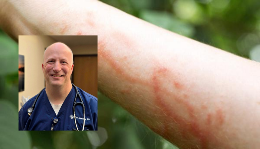 Tim M and Poison Ivy Rash Poison Ivy Rash