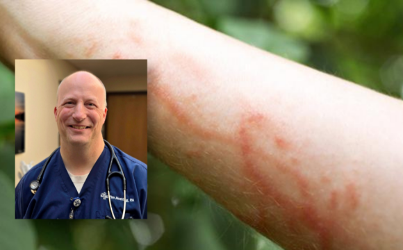Tim Montag and Poison Ivy Rash Medical Staff and Poison Ivy Rash