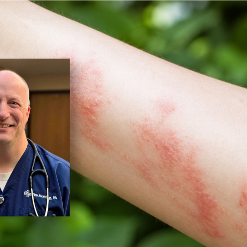 Tim Montag and Poison Ivy Rash on arm Medical Staff and Poison Ivy Rash