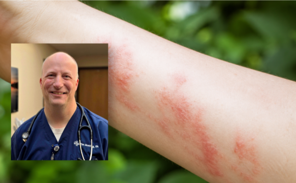 Medical Staff and Poison Ivy Rash