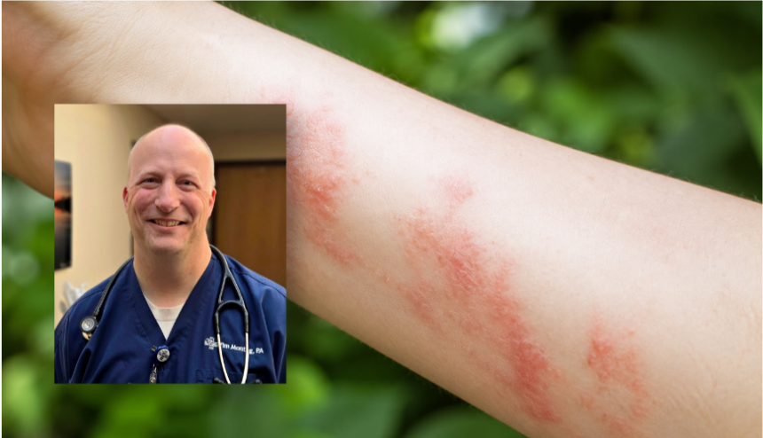 Medical Staff and Poison Ivy Rash